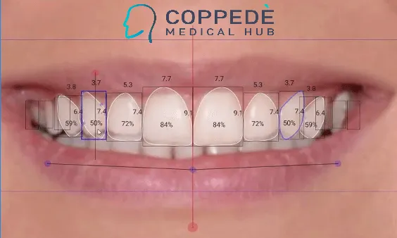 Risultato finale di Digital Smile Design a Roma: sorriso armonico e naturale progettato in 3D dai dottori Brauner.