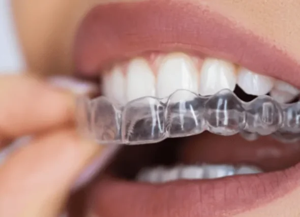 Primo piano di una persona che posiziona un allineatore dentale trasparente sui denti superiori, per mostrare l'ortodonzia-invisibile presso il Coppede Medical Hub Roma.